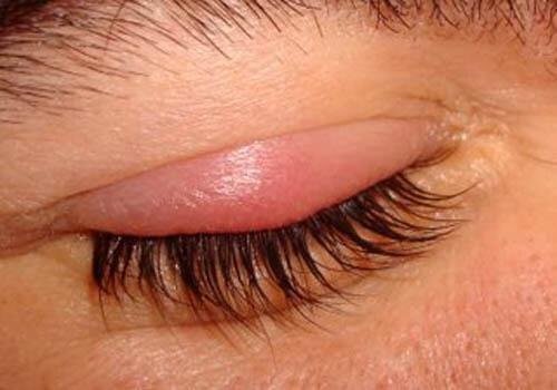 Mites or lice can cause blepharitis.
