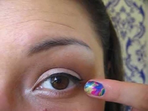 Woman pointing at eye with blepharitis.