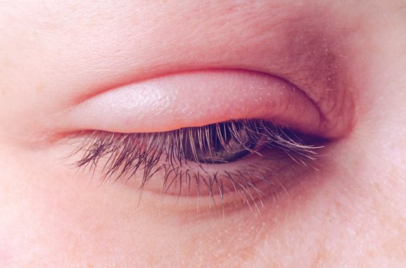 Blepharitis: Causes, Symptoms and Treatment - Step To Health