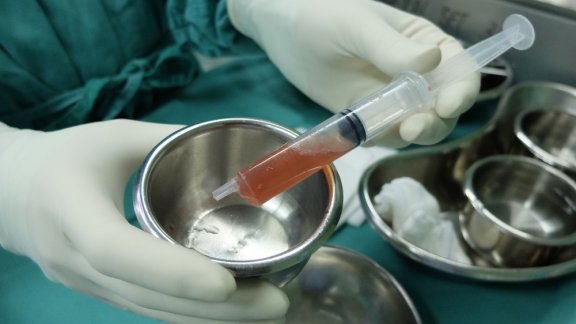 Information and Steps to Treat Ascites
