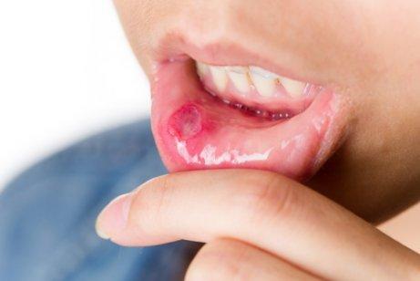 A man with a mouth sore.