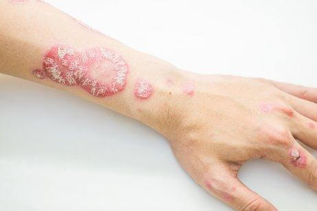An arm with psoriasis.