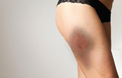 To treat bruises, put some meat on it.