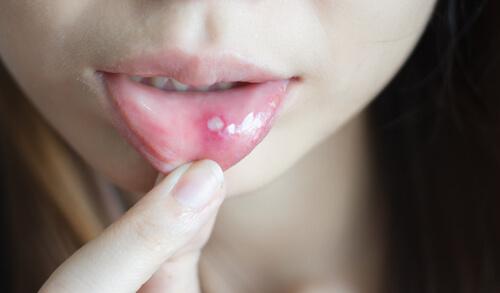 Canker and Mouth Sores - How to Cure Them