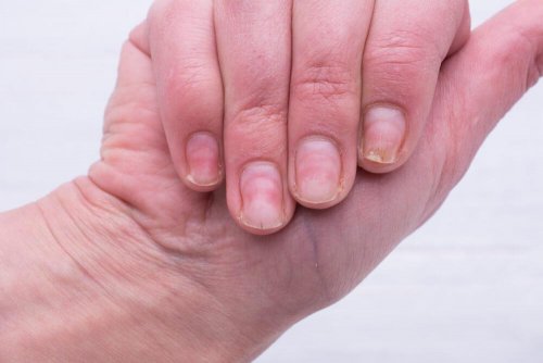 Natural Remedies for Yellow Nails
