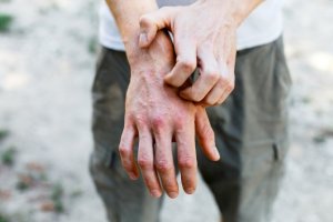 6 Home Remedies to Treat Contact Dermatitis