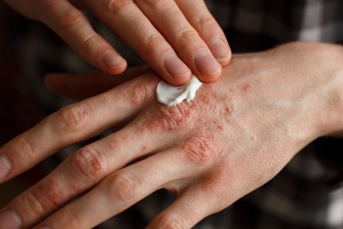 A person applying cream to a hand affected with psoriasis.