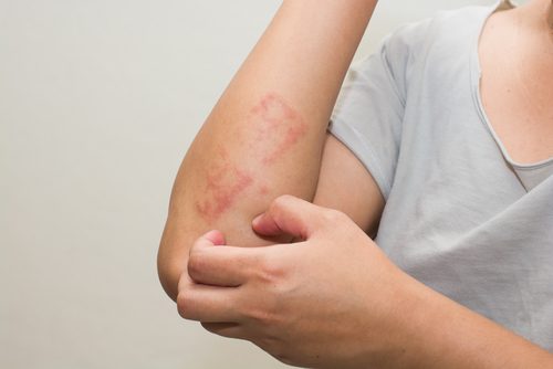 A person scratching their elbows with psoriasis.