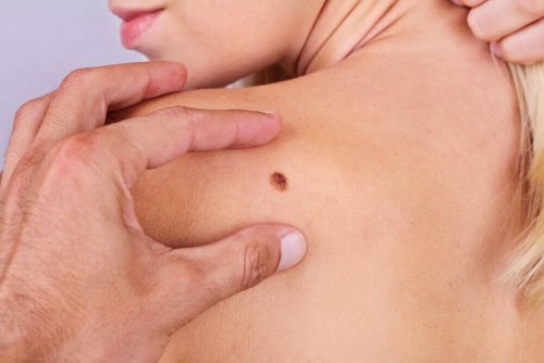 A malignant melanoma.