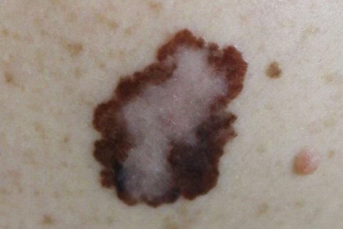 A malignant melanoma.