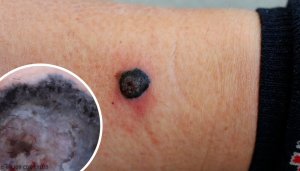 What Is a Malignant Melanoma?