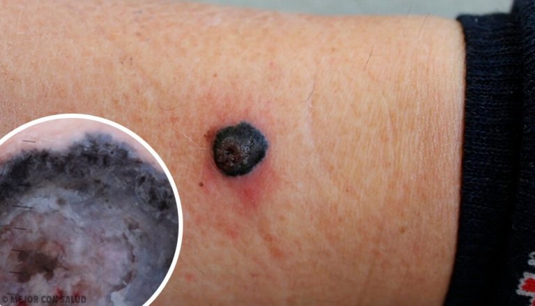 What Is a Malignant Melanoma?