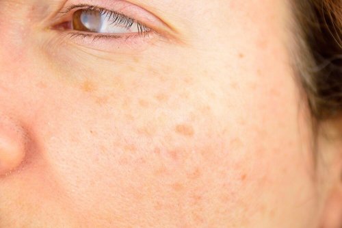 A person with reduced freckles because she used potato peels.