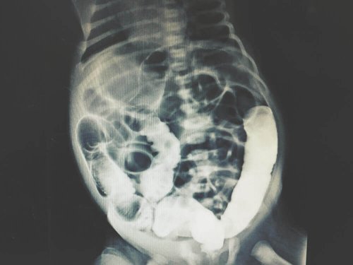 X-ray peritoneal dialysis