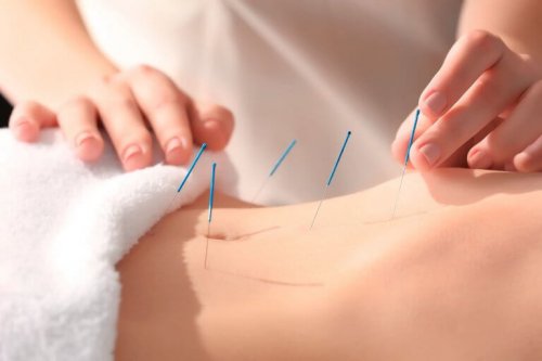 acupuncture benefits