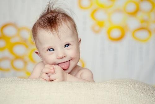 A baby with Down syndrome.