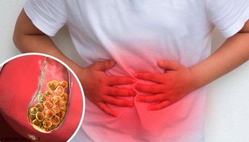 facts about gallstones