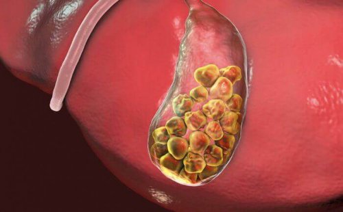 gallbladder with gallstones