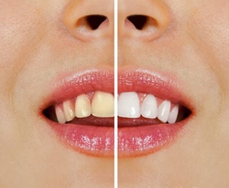 Natural Products to Whiten Teeth