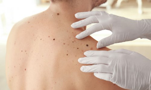 A freckled person's back.