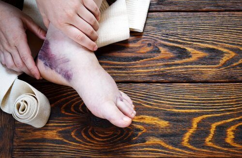 Heal a Sprained Ankle with Complementary Remedies