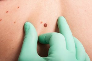 What is The ABCDE Test in Dermatology?