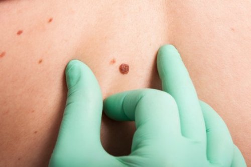 The ABCDE Test for Skin Cancer