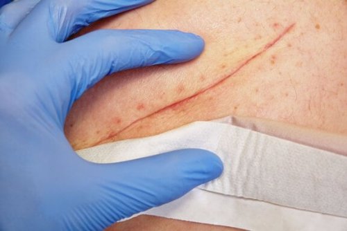 Basic Wound Closure Techniques
