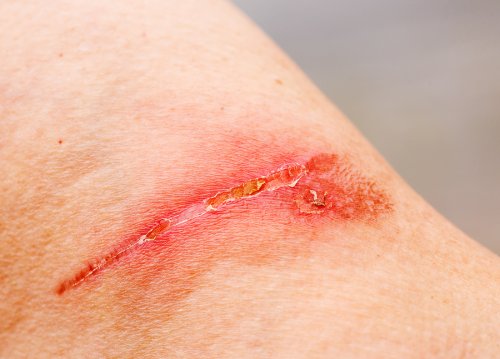 Wound that's healing