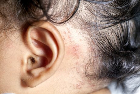 A baby with psoriasis.