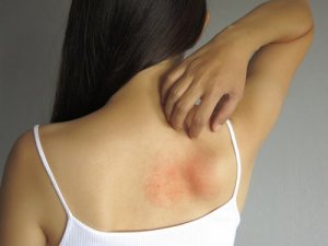5 Topical Remedies to Relieve Rashes