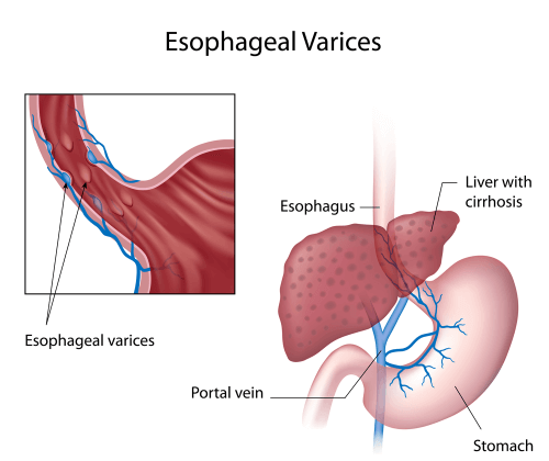 Signs and symptoms of esophageal varices