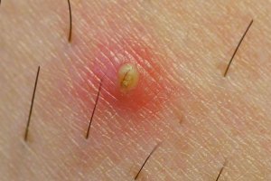 How to Prevent Ingrown Hair