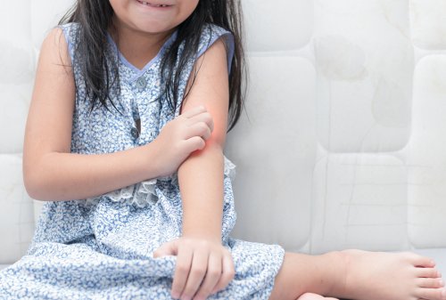 How to Deal with Psoriasis in Children