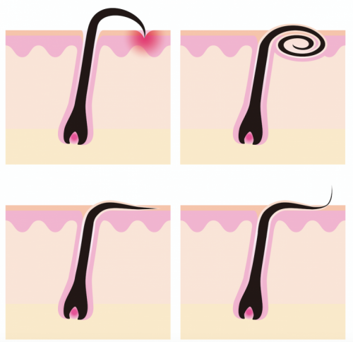 ingrown hair types