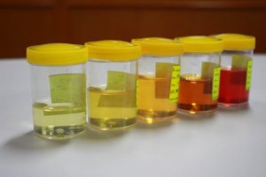 Things Taken into Account Regarding Urine Abnormalities