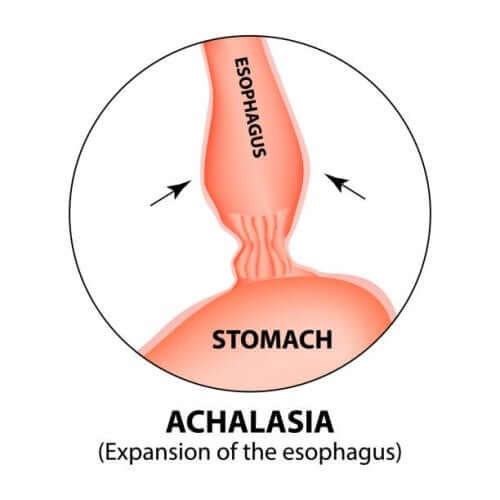 A diagram of Esophageal achalasia.