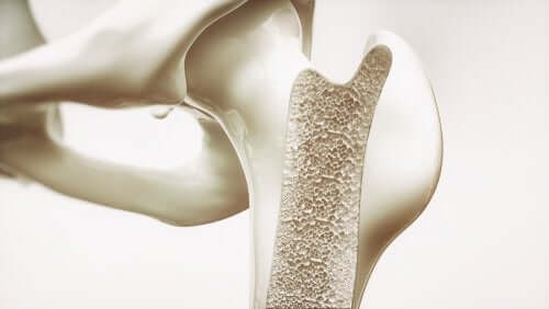 An illustration of osteoporosis.