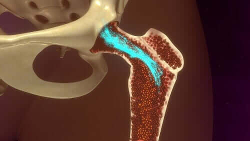 A picture of a hypocalcemic bone.