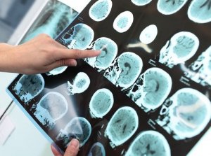 Major neurocognitive disorder