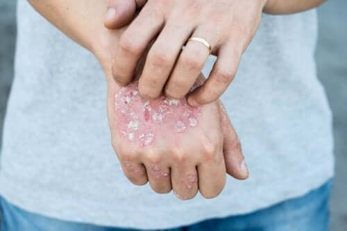 Utslag av psoriasis