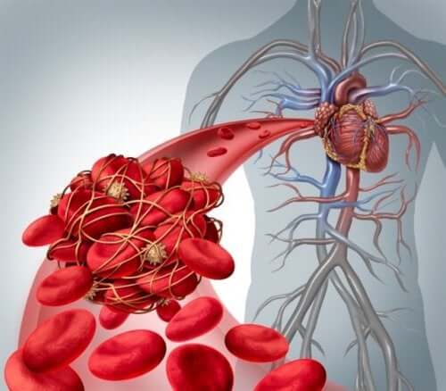 A diagram of deep vein thrombosis.