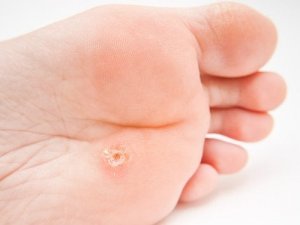 Plantar Warts: Characteristics and Treatment
