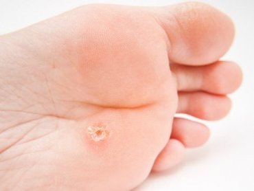 plantar warts treatment wart