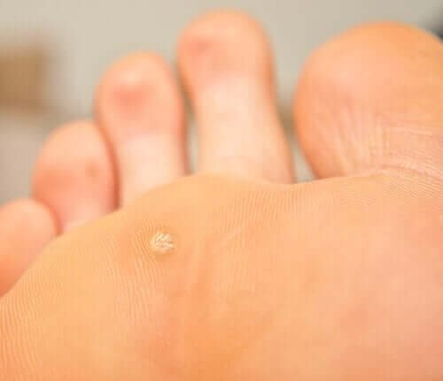 A plantar wart in a foot.