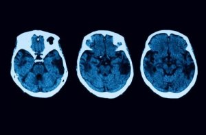 Posterior Cortical Atrophy Diagnosis and Treatment