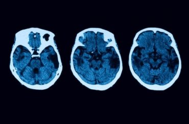 Posterior Cortical Atrophy Diagnosis and Treatment - Step To Health