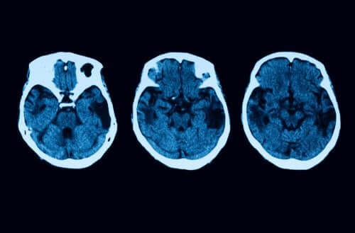 Posterior Cortical Atrophy Diagnosis and Treatment