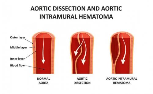 aortic dissection artery vessels