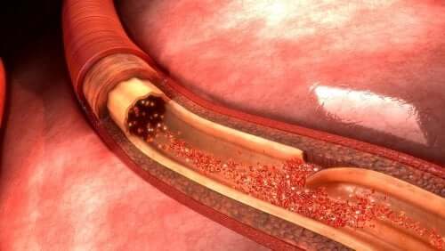 Aortic Dissection: What It is and What Causes it